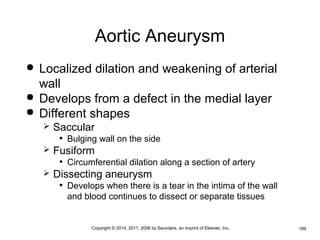 Aortic Aneurysm 
 Localized dilation and weakening of arterial 
wall 
 Develops from a defect in the medial layer 
 Different shapes 
 Saccular 
• Bulging wall on the side 
 Fusiform 
• Circumferential dilation along a section of artery 
 Dissecting aneurysm 
• Develops when there is a tear in the intima of the wall 
and blood continues to dissect or separate tissues 
•Copyright © 2014, 2011, 2006 by Saunders, an imprint of Elsevier, Inc. •189 
 