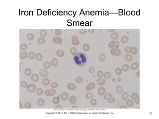 Iron Deficiency Anemia—Blood 
Smear 
•Copyright © 2014, 2011, 2006 by Saunders, an imprint of Elsevier, Inc. •27 
 