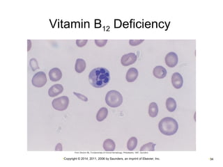 Vitamin B12 Deficiency 
•Copyright © 2014, 2011, 2006 by Saunders, an imprint of Elsevier, Inc. •34 
 