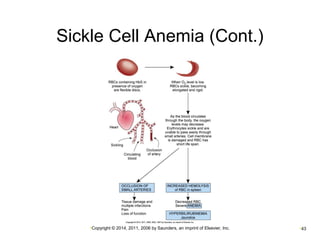 Sickle Cell Anemia (Cont.) 
•Copyright © 2014, 2011, 2006 by Saunders, an imprint of Elsevier, Inc. •43 
 