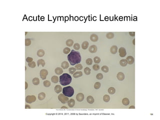 Acute Lymphocytic Leukemia 
•Copyright © 2014, 2011, 2006 by Saunders, an imprint of Elsevier, Inc. •64 
 