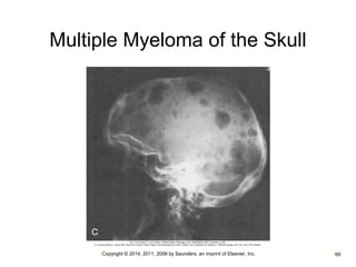 Multiple Myeloma of the Skull 
•Copyright © 2014, 2011, 2006 by Saunders, an imprint of Elsevier, Inc. •69 
 
