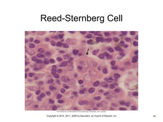 Reed-Sternberg Cell 
•Copyright © 2014, 2011, 2006 by Saunders, an imprint of Elsevier, Inc. •81 
 