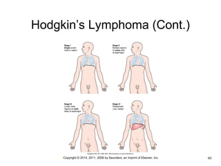 Hodgkin’s Lymphoma (Cont.) 
•Copyright © 2014, 2011, 2006 by Saunders, an imprint of Elsevier, Inc. •83 
 