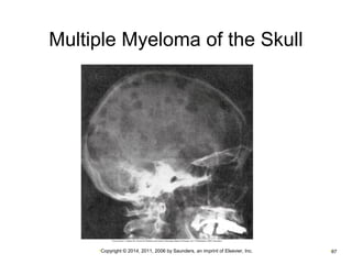 Multiple Myeloma of the Skull 
•Copyright © 2014, 2011, 2006 by Saunders, an imprint of Elsevier, Inc. •87 
 