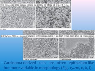 ∗ Carcinoma-derived cells are often epithelium-like
but more variable in morphology (Fig. 15.2m, n, k, l)

 
