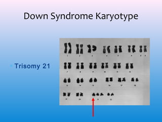 Down Syndrome Karyotype

∗ Trisomy 21

 