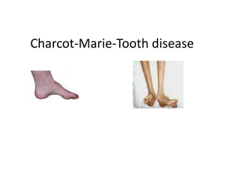 Charcot-Marie-Tooth disease
 