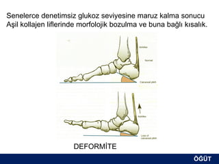 Senelerce denetimsiz glukoz seviyesine maruz kalma sonucu
Aşil kollajen liflerinde morfolojik bozulma ve buna bağlı kısalık.




                      DEFORMİTE
                                                             ÖĞÜT
                                                              ÖĞÜT
 