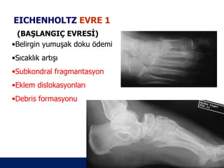 EICHENHOLTZ EVRE 1
 (BAŞLANGIÇ EVRESİ)
•Belirgin yumuşak doku ödemi
•Sıcaklık artışı
•Subkondral fragmantasyon
•Eklem dislokasyonları
•Debris formasyonu




                               ÖĞÜT
                                ÖĞÜT
 