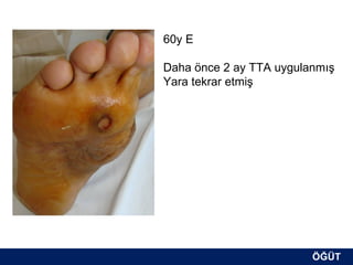 60y E

Daha önce 2 ay TTA uygulanmış
Yara tekrar etmiş




                         ÖĞÜT
                          ÖĞÜT
 
