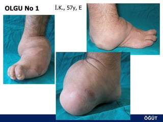 OLGU No 1   İ.K., 57y, E




                           ÖĞÜT
                            ÖĞÜT
 