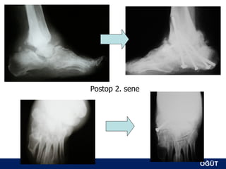 Postop 2. sene




                 ÖĞÜT
                  ÖĞÜT
 