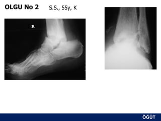 OLGU No 2   S.S., 55y, K




                           ÖĞÜT
                            ÖĞÜT
 