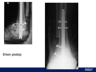 Erken postop



               ÖĞÜT
                ÖĞÜT
 