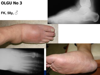 OLGU No 3

FK, 58y, ♂




             ÖĞÜT
              ÖĞÜT
 