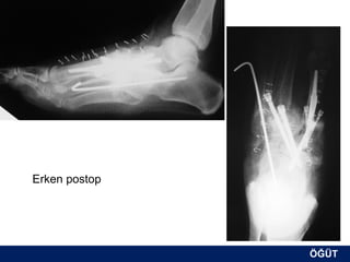 Erken postop




               ÖĞÜT
                ÖĞÜT
 