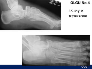 OLGU No 4

FK, 51y, K
10 yıldır oralad




           ÖĞÜT
            ÖĞÜT
 