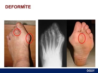 DEFORMİTE
Normal şekil ve dizilimden sapma




                                   ÖĞÜT
                                    ÖĞÜT
 