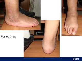 Postop 3. ay




               ÖĞÜT
                ÖĞÜT
 