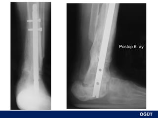 Postop 6. ay




          ÖĞÜT
           ÖĞÜT
 