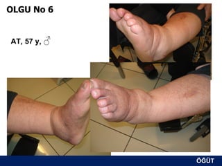 OLGU No 6


AT, 57 y, ♂




              ÖĞÜT
               ÖĞÜT
 