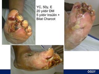 YC, 50y, E
20 yıldır DM
5 yıldır Insülin +
Bilat Charcot




                     ÖĞÜT
                      ÖĞÜT
 
