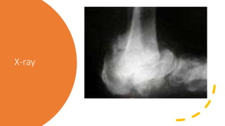 X-ray
X-ray:
Diagnosis: Acute charcot arthropathy
 