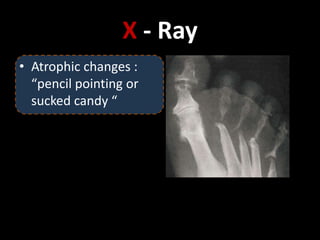 X - Ray
• Atrophic changes :
“pencil pointing or
sucked candy “
 