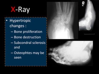 X-Ray
• Hypertropic
changes :
– Bone proliferation
– Bone destruction
– Subcondral sclerosis
and
– Osteophtes may be
seen
 