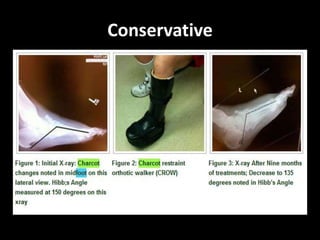 Conservative
 Immobilization and off loading
• Reducing swelling and mechanical stress 
elevation, bed rest, whell chair
• TCC  Total Contact Cast
 