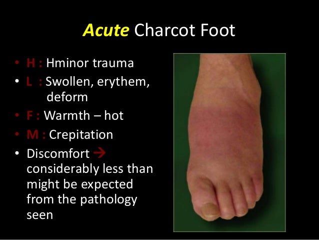 Charcot foot