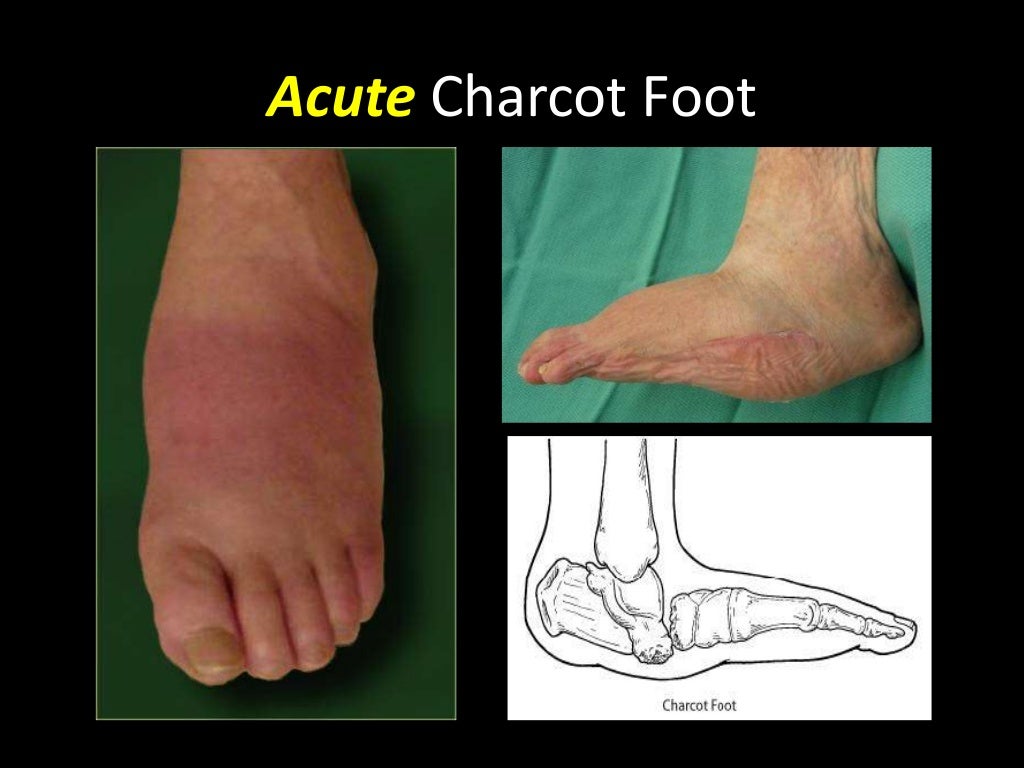 Charcot foot