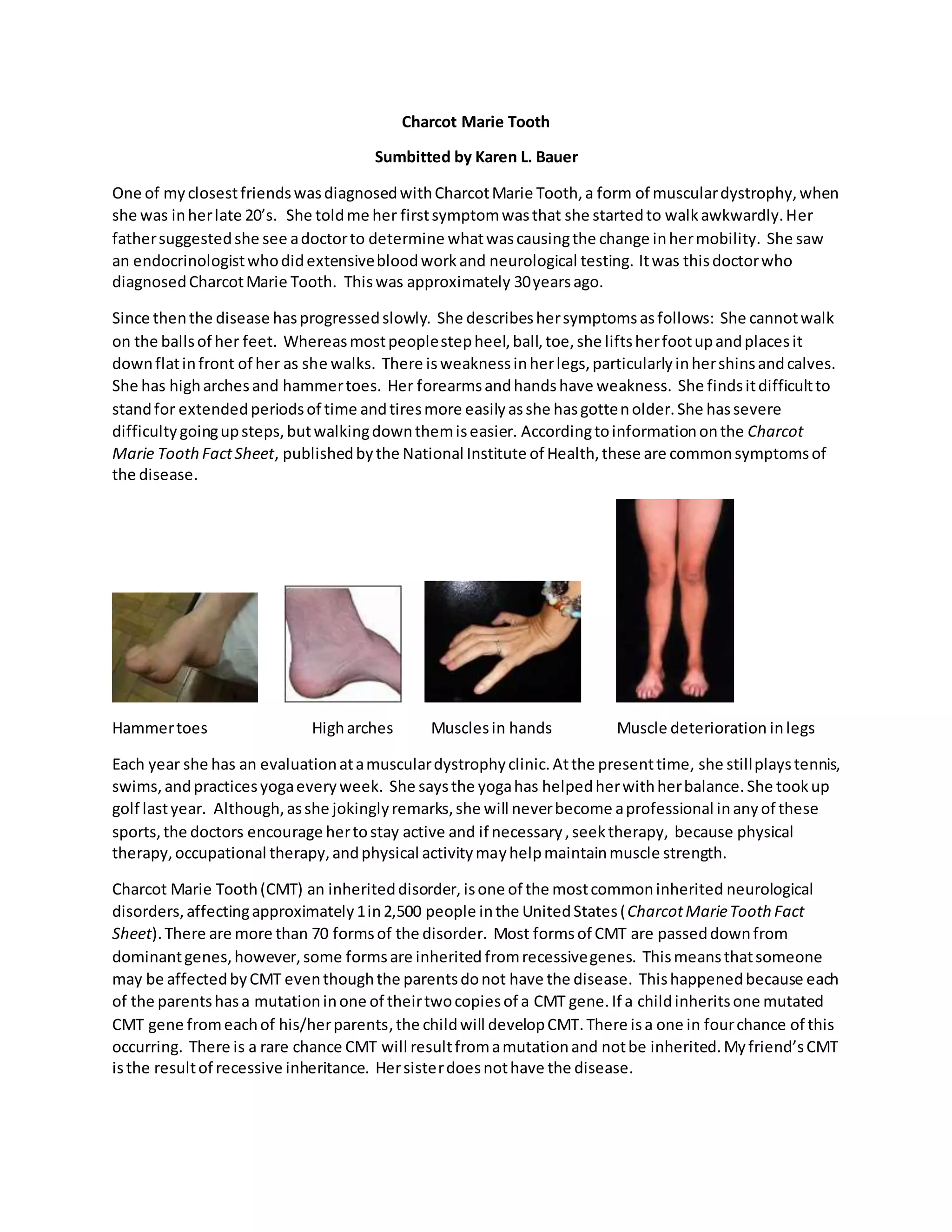 Tooth Toe Charcot marie tooth | DOCX