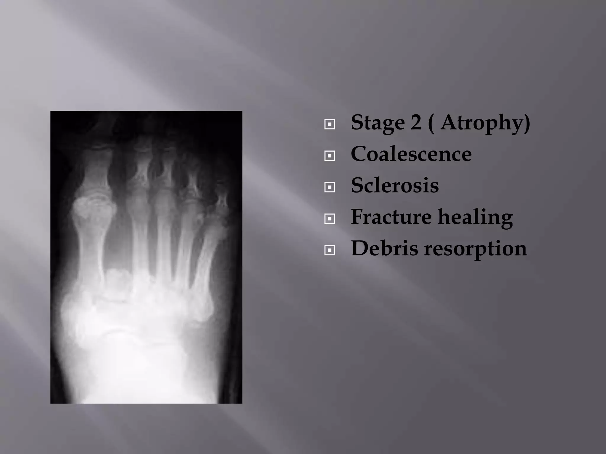 Charcot joint / Neuropathic Joint | PPTX
