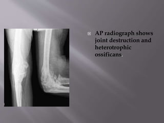  AP radiograph shows
joint destruction and
heterotrophic
ossificans.
 