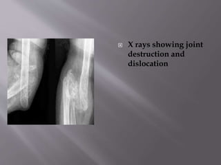  X rays showing joint
destruction and
dislocation
 