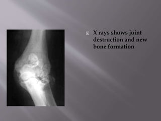  X rays shows joint
destruction and new
bone formation
 