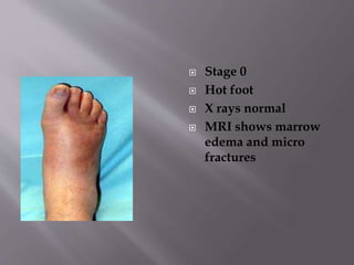  Stage 0
 Hot foot
 X rays normal
 MRI shows marrow
edema and micro
fractures
 