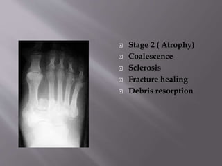  Stage 2 ( Atrophy)
 Coalescence
 Sclerosis
 Fracture healing
 Debris resorption
 