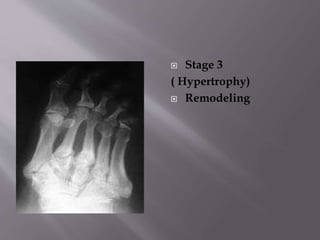  Stage 3
( Hypertrophy)
 Remodeling
 