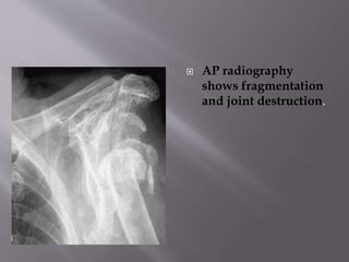  AP radiography
shows fragmentation
and joint destruction.
 