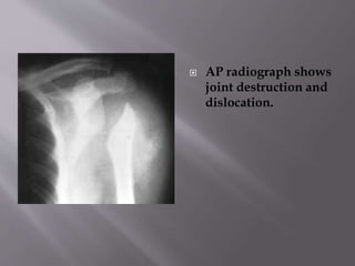  AP radiograph shows
joint destruction and
dislocation.
 