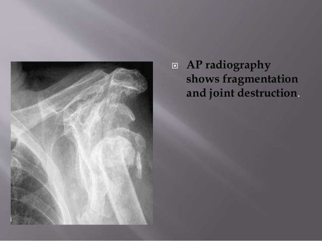 Charcot joint / Neuropathic Joint