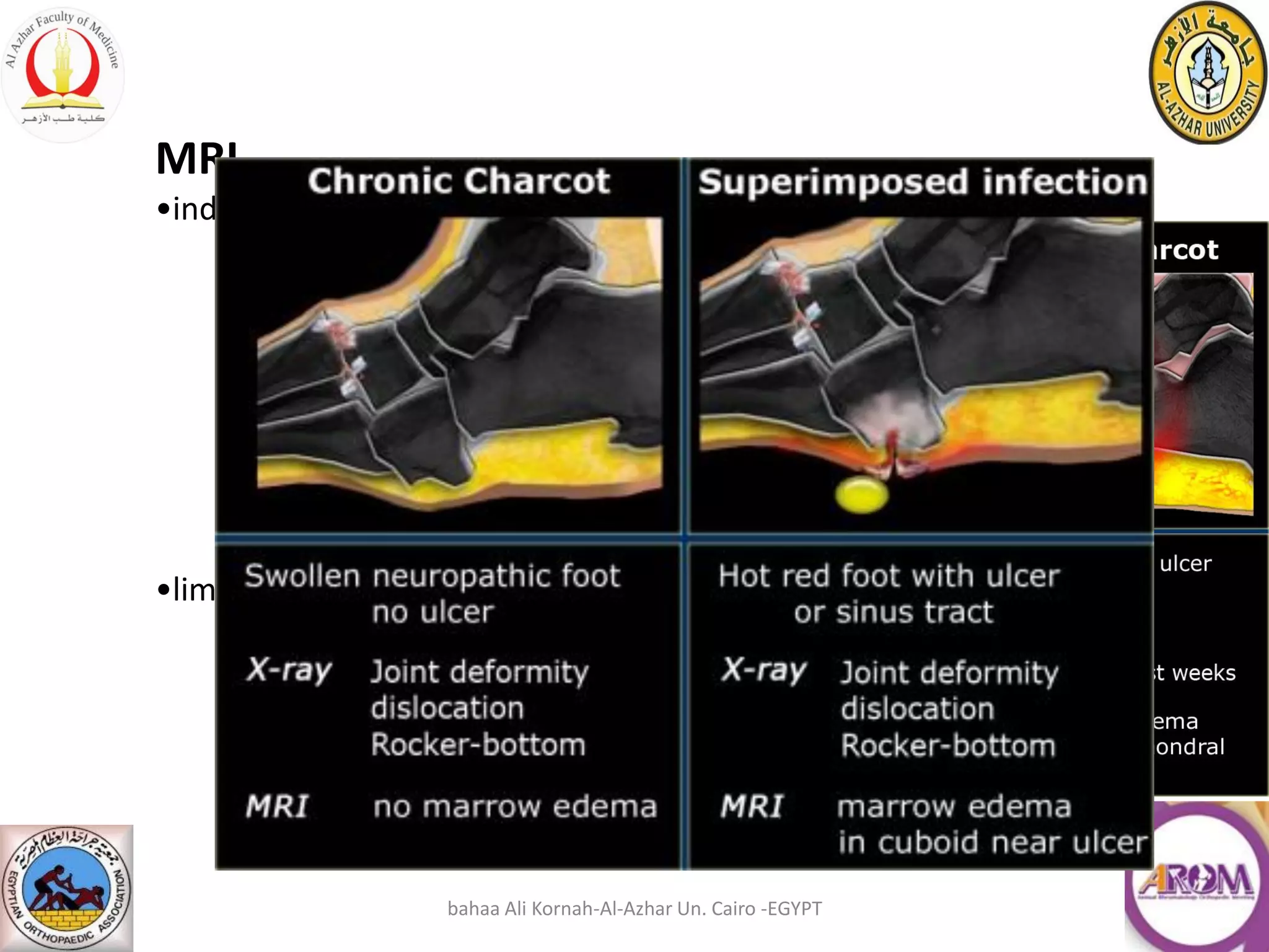 Charcot neuropathy. | PDF