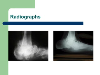 CHARCOT NEUROPATHY of human body in physiotherapy | PPT
