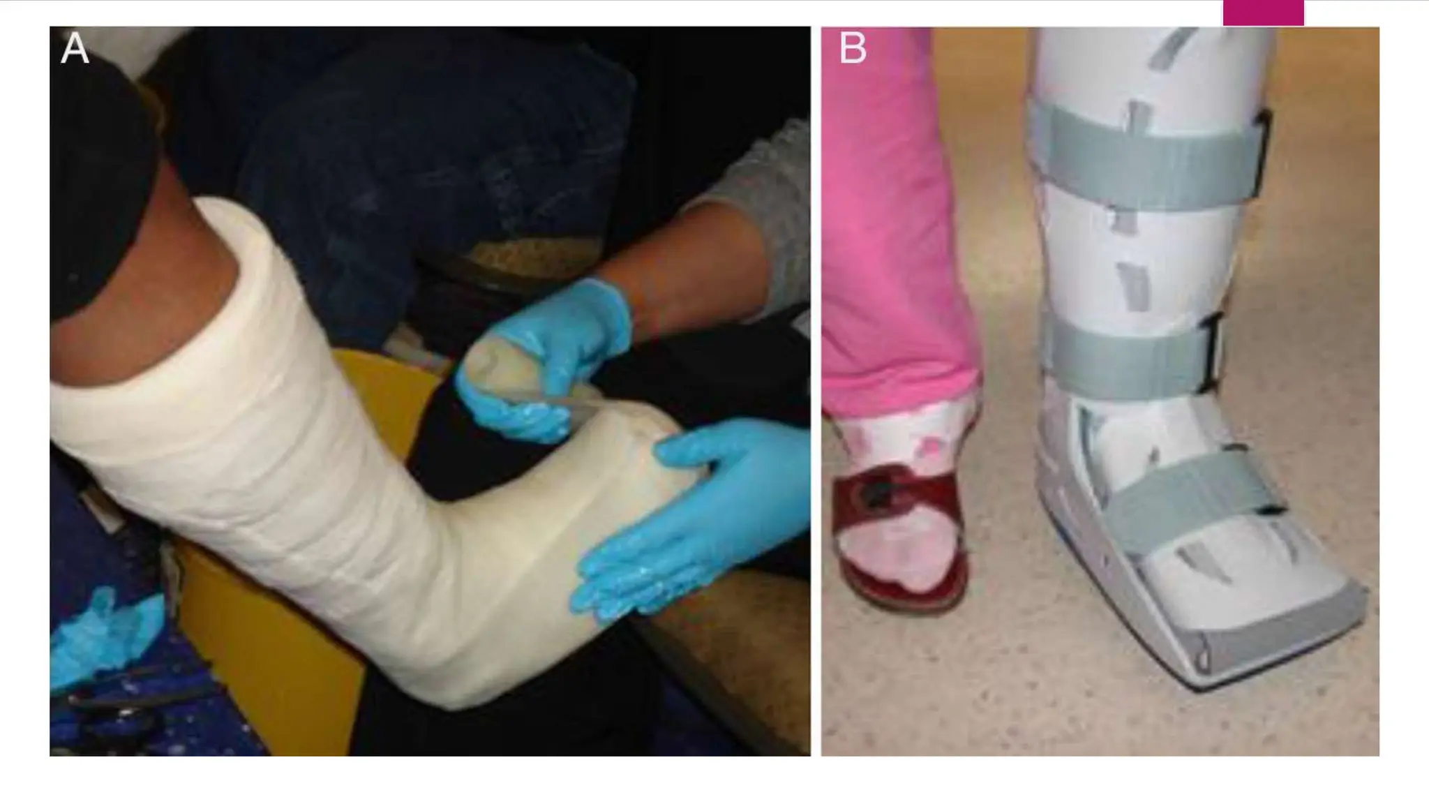CHARCOT'S JOINT- ORTHOPEDIC PRESENTATION.pptx
