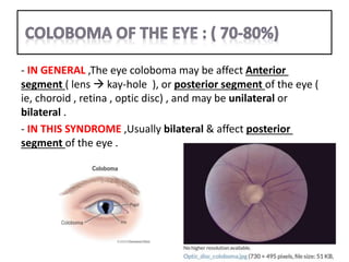 CHARGE SYNDROME.pptx