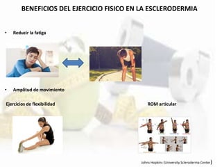 BENEFICIOS DEL EJERCICIO FISICO EN LA ESCLERODERMIA
• Reducir la fatiga
• Amplitud de movimiento
Ejercicios de flexibilidad ROM articular
Johns Hopkins (University Scleroderma Center)
 