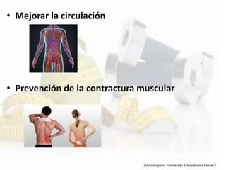 • Mejorar la circulación
• Prevención de la contractura muscular
Johns Hopkins (University Scleroderma Center)
 